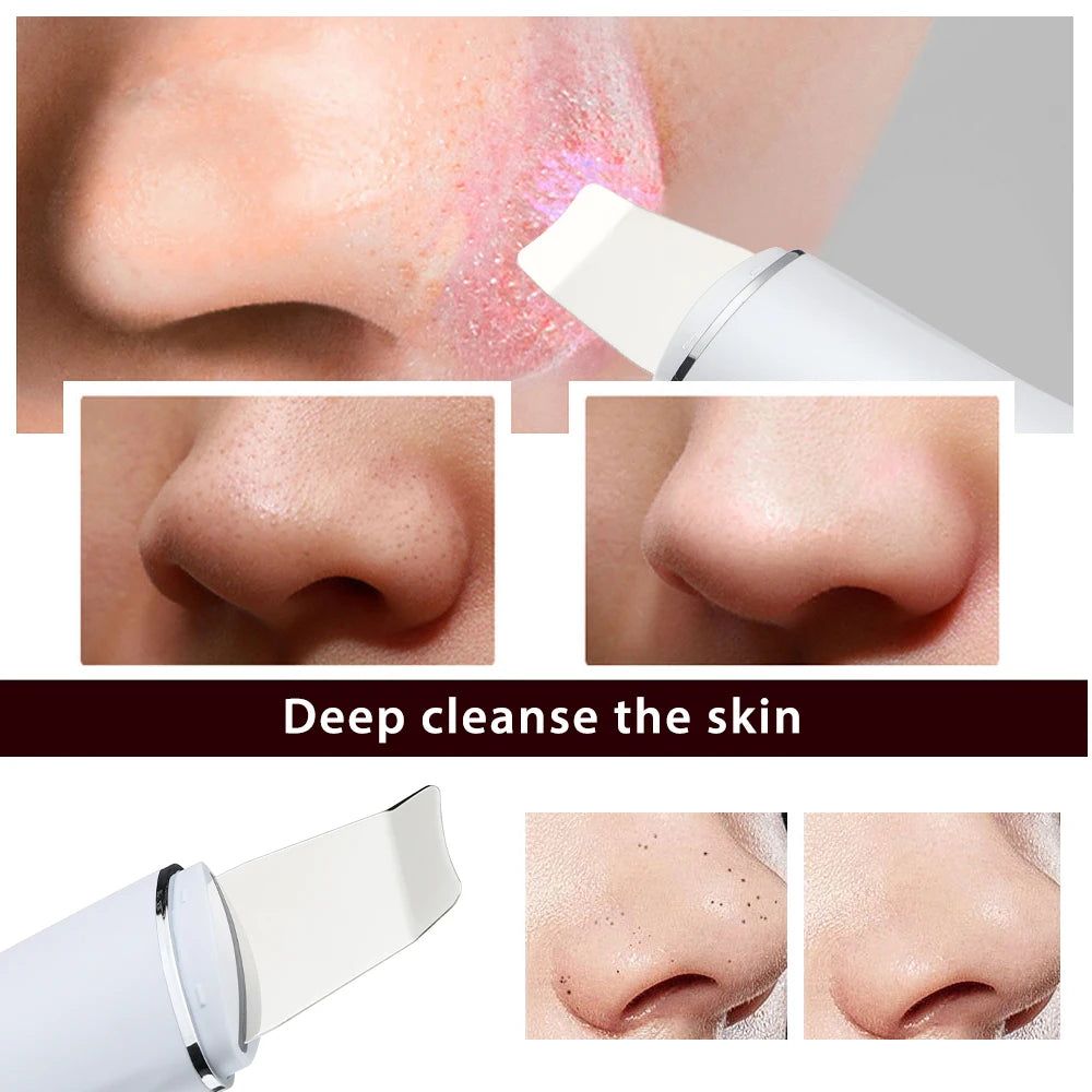 Nettoyeur de pores électrique – Outil professionnel de soins de la peau